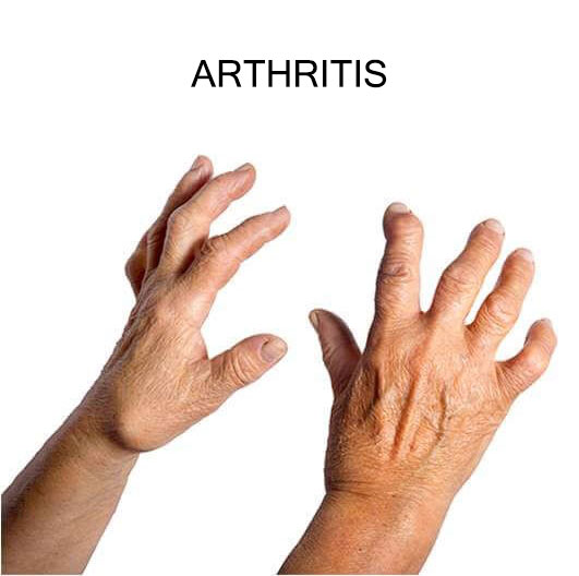 Arthritis Treatment