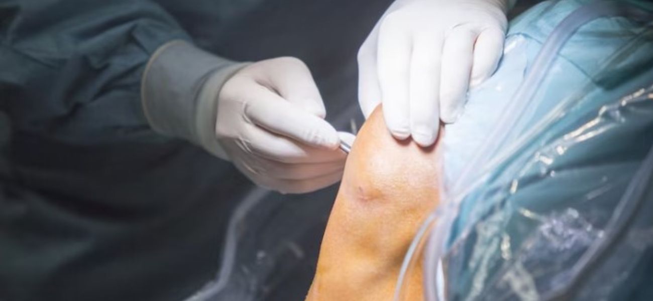 Cost of Knee Arthroscopy Surgery in Ahmedabad, Gujarat, India